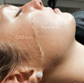 Dermaplane Facial